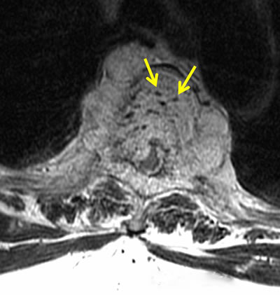 На МРТ позвоночника гемангиома отличается от метастазов других злокачественных новообразованийналичием наличием утолщенний трабекул (стрелки) в пораженных телах позвонков.