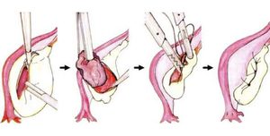 Орхиэктомия при раке предстательной железы или яичка