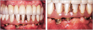Фото: Налет на имплантах и искусственных зубах