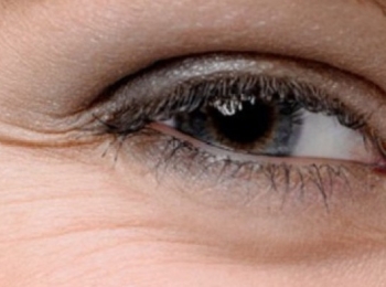 Морщинки вокруг глаз и дряблость кожи век - основныые показания к применению наполнителей