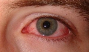 красные глаза после алкоголя