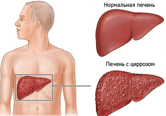 Хронический гепатит может спровоцировать цирроз печени