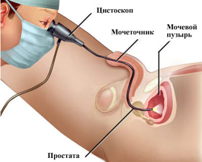 Уретроцистоскопия