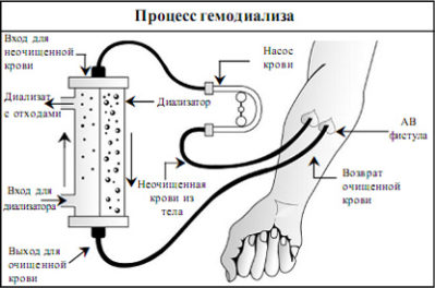 процесс гемодиализа
