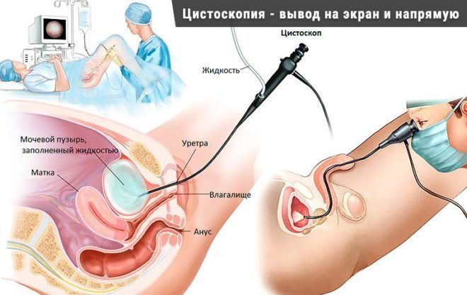 Как делают цистоскопию