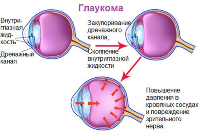 Глаукома может образоваться от применения специальных гормональных глазных гелей во время распития спиртных напитков