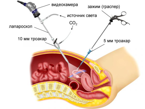 Лапароскопия (схема)