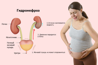 Гидронефроз почки при беременности