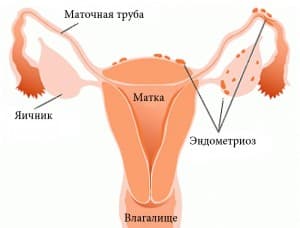 Эндометриоз матки 