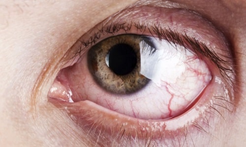 Нистагм - это заболевание глаз, и одна из причин его развития - это чрезмерное употребление спиртного