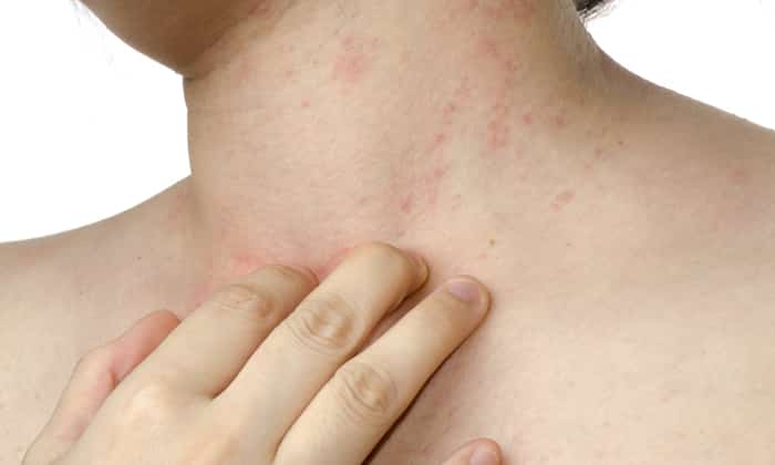 Еще одним побочным эффектом может быть аллергическая сыпь