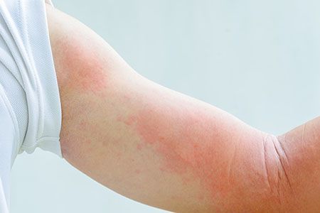 аллергия на руке у женщины