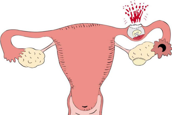 Эктопическая беременность и разрыв кисты схожи по симптоматике