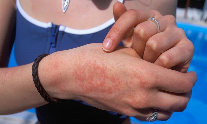 Препарат может вызвать аллергическую реакцию в виде высыпания на поверхности кожи