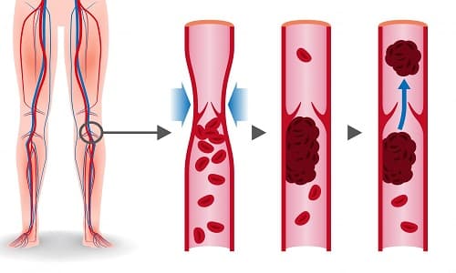 Цианокобаламин повышает вязкость крови, поэтому может увеличить риск тромбозов