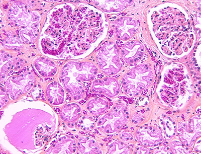 Гломерулонефрит (картина под микроскопом)