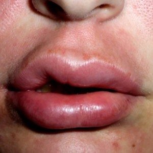 сколько держится отек после увеличения губ